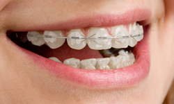 Transparent or Ceramic Braces in Wilmington - Wilmington